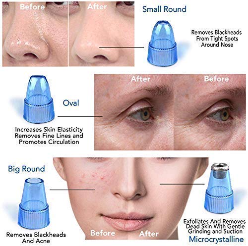 Derma Suction Pore Cleaning Device – Vacuum-Powered Facial Tool for Deep Pore Cleansing and Blackhead Removal Premium Quality Single Deals™