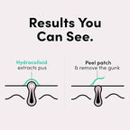 Hydrocolloid Acne Patch Set – 36-Piece Targeted Spot Treatment for Clear, Protected Skin Premium Quality Single Deals™