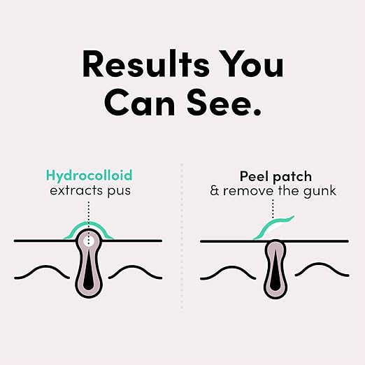 Hydrocolloid Acne Patch Set – 36-Piece Targeted Spot Treatment for Clear, Protected Skin Premium Quality Single Deals™