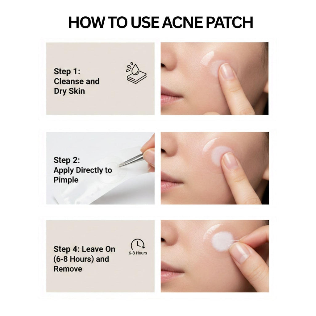 Skin-Tone Hydrocolloid Acne Patch Set – 36-Piece Targeted Spot Treatment for Discreet Blemish Care