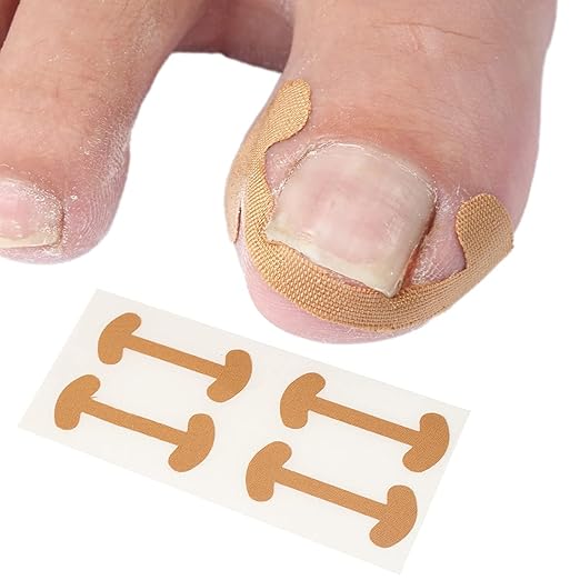 Ingrown Toenail Correction Patch -1 Strip  Professional Paronychia Treatment Sticker for Pain Relief and Nail Alignment Premium Quality Single Deals™
