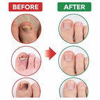 Fungal Nail Repair Patches - 21 Count Hydrogel Treatment Strips for Brittle, Discolored Nails - Overnight Hygienic Application Premium Quality Single Deals™