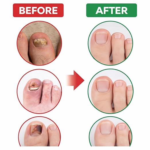 Fungal Nail Repair Patches - 21 Count Hydrogel Treatment Strips for Brittle, Discolored Nails - Overnight Hygienic Application Premium Quality Single Deals™