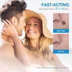 Auto Skin Tag Remover Kit – Sophisticated Personal Care Solution Premium Quality SingleDeals™