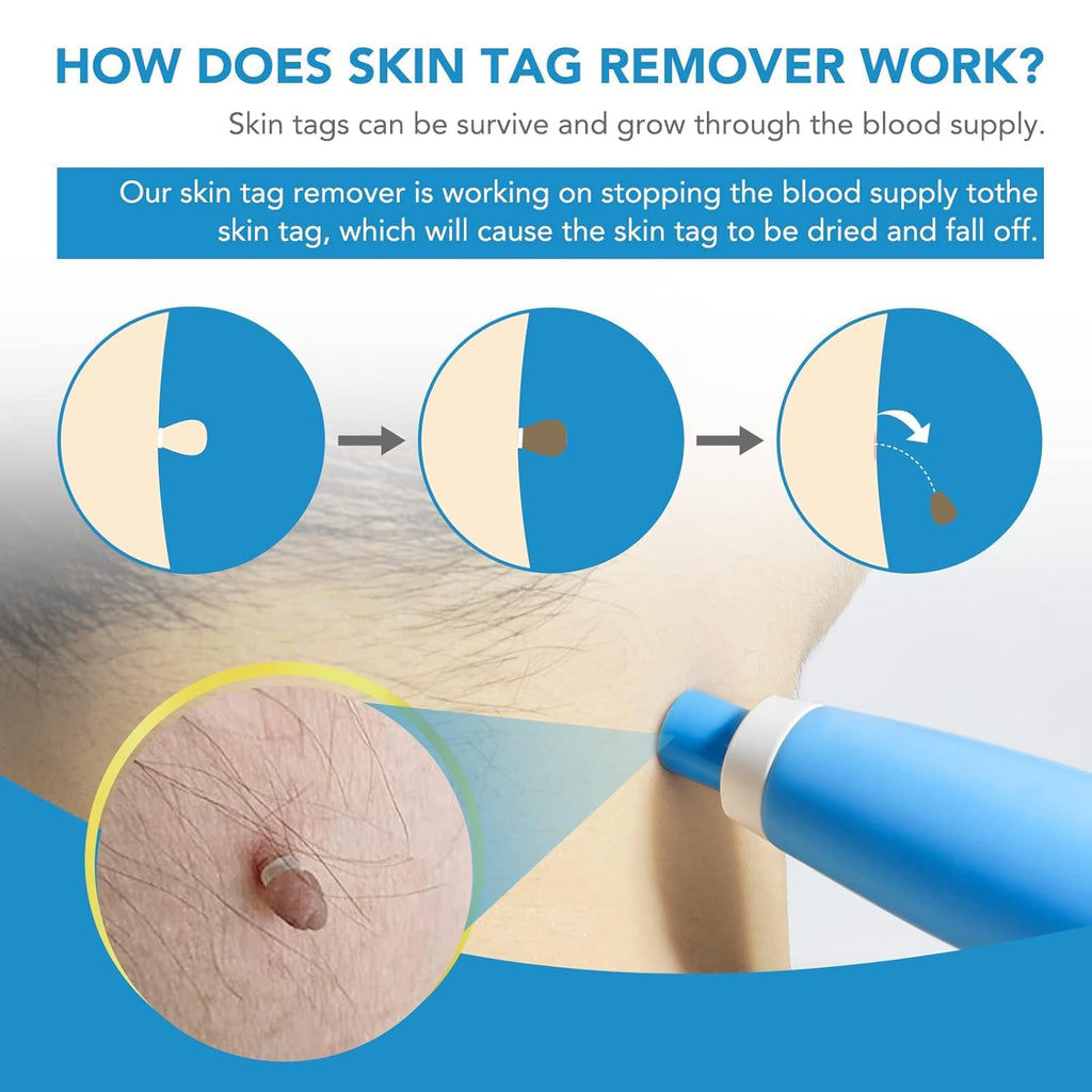 Auto Skin Tag Remover Kit – Sophisticated Personal Care Solution Premium Quality SingleDeals™