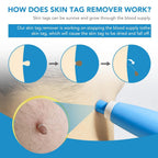 Auto Skin Tag Remover Kit – Sophisticated Personal Care Solution Premium Quality SingleDeals™