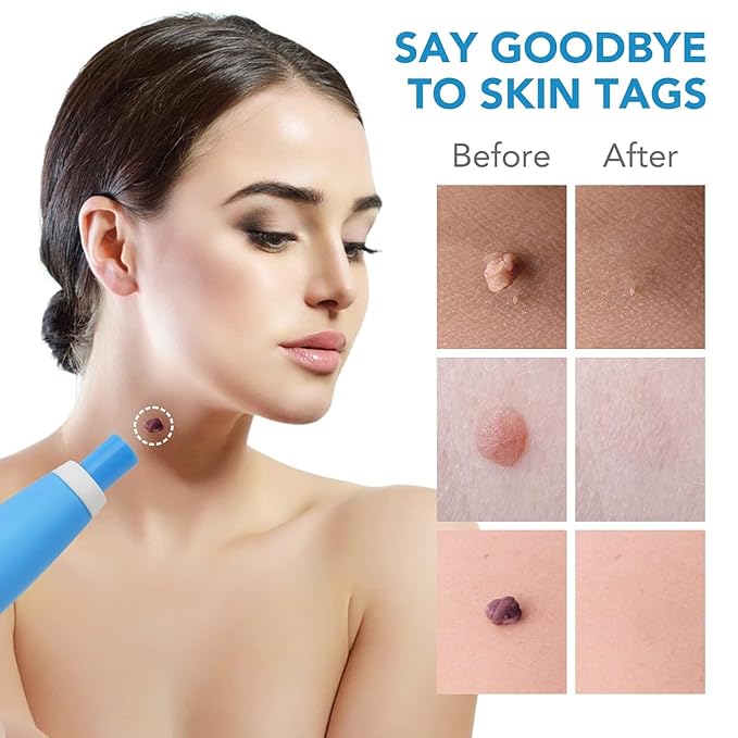 Auto Skin Tag Remover Kit – Sophisticated Personal Care Solution Premium Quality SingleDeals™